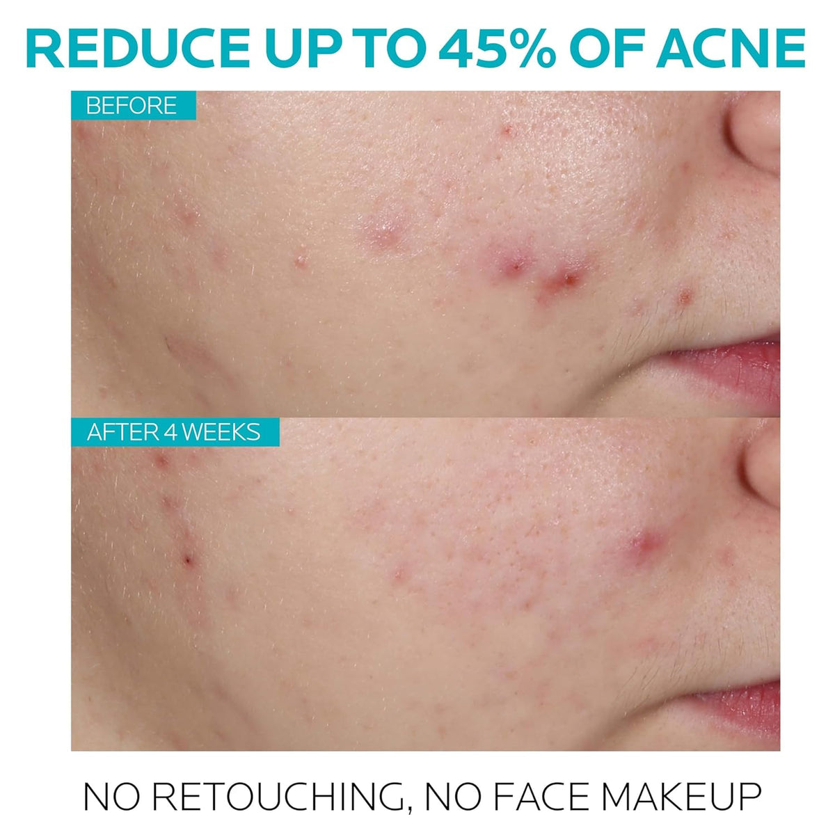 La Roche-Posay Effaclar Salicylic Acid Acne Treatment Serum